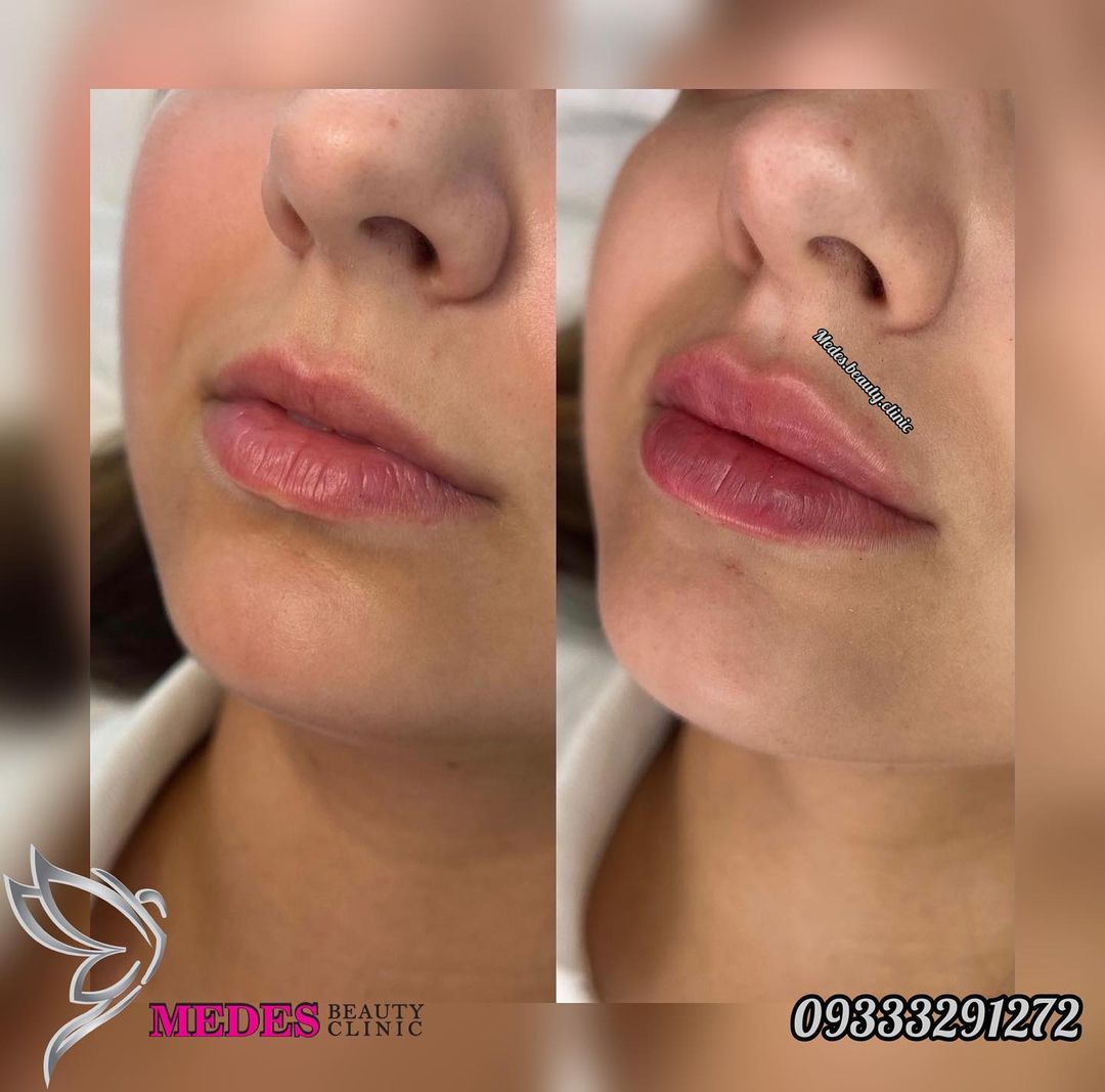 گالری تزریق ژل لب